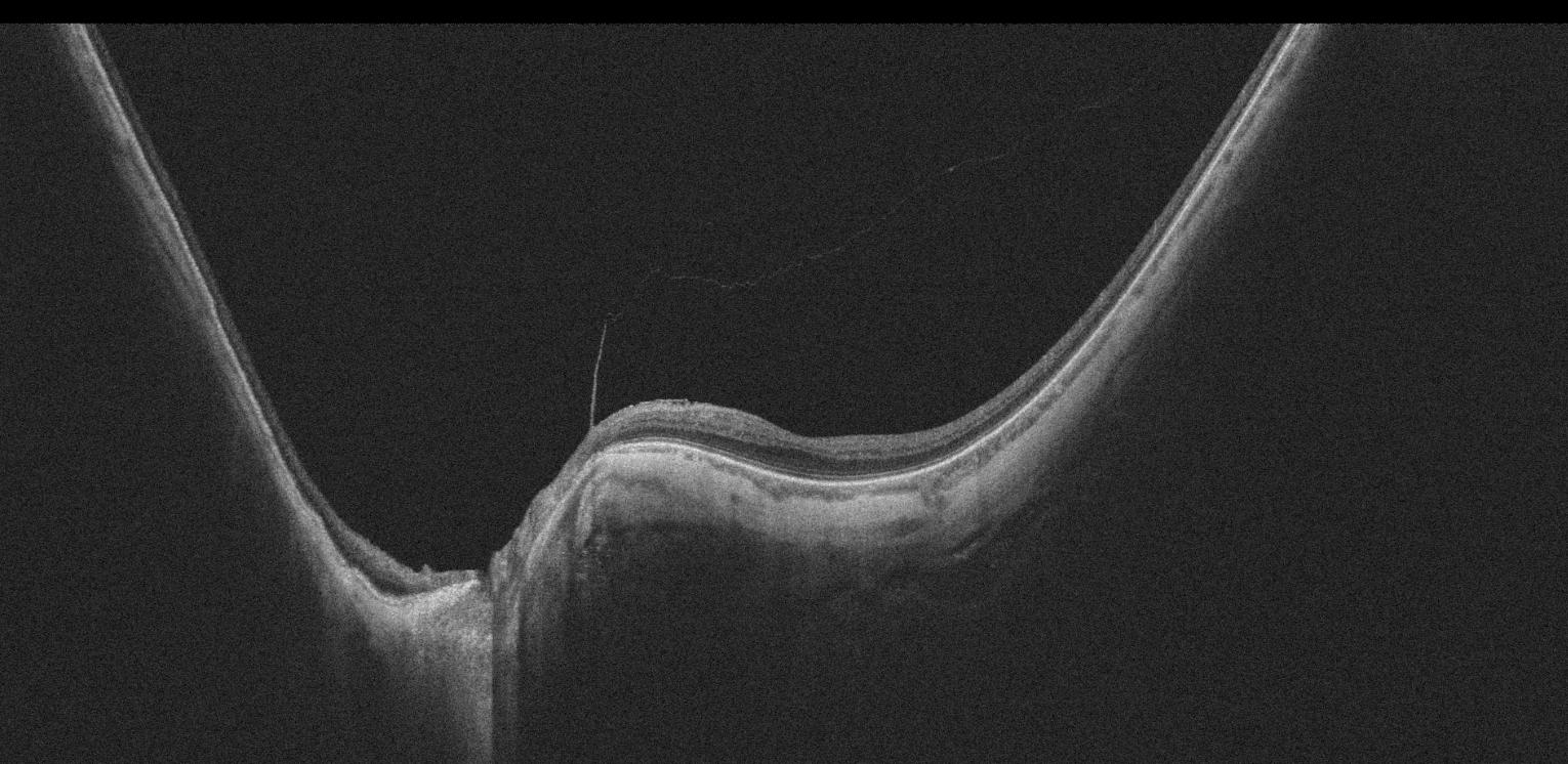OCT Intalight montrant un staphylome myopique péripapillaire